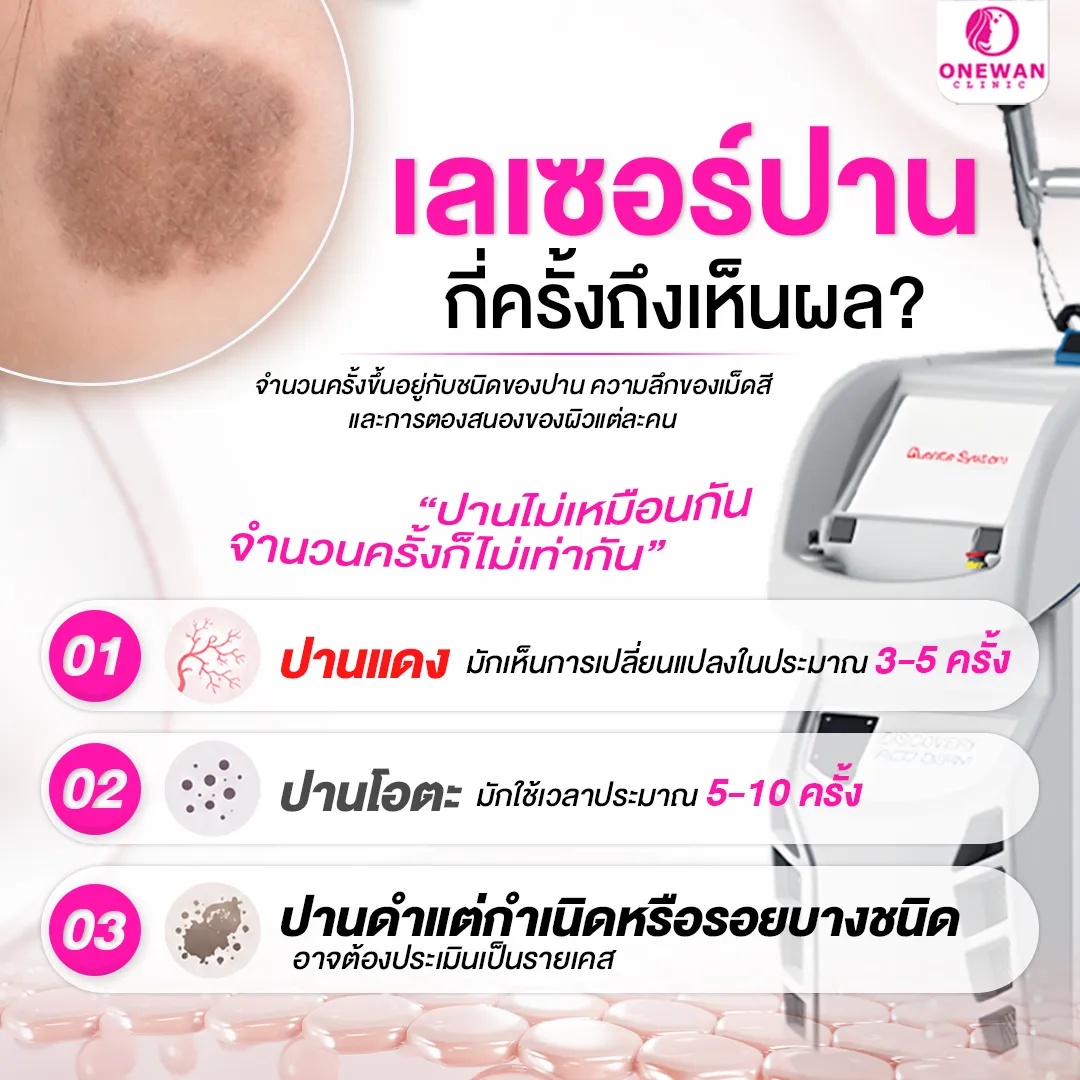 เลเซอร์ปานกี่ครั้งถึงเห็นผล