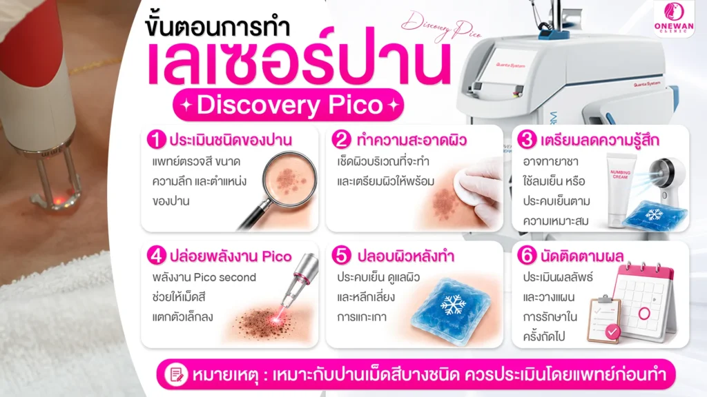 ขั้นตอนการทำเลเซอร์ปาน
