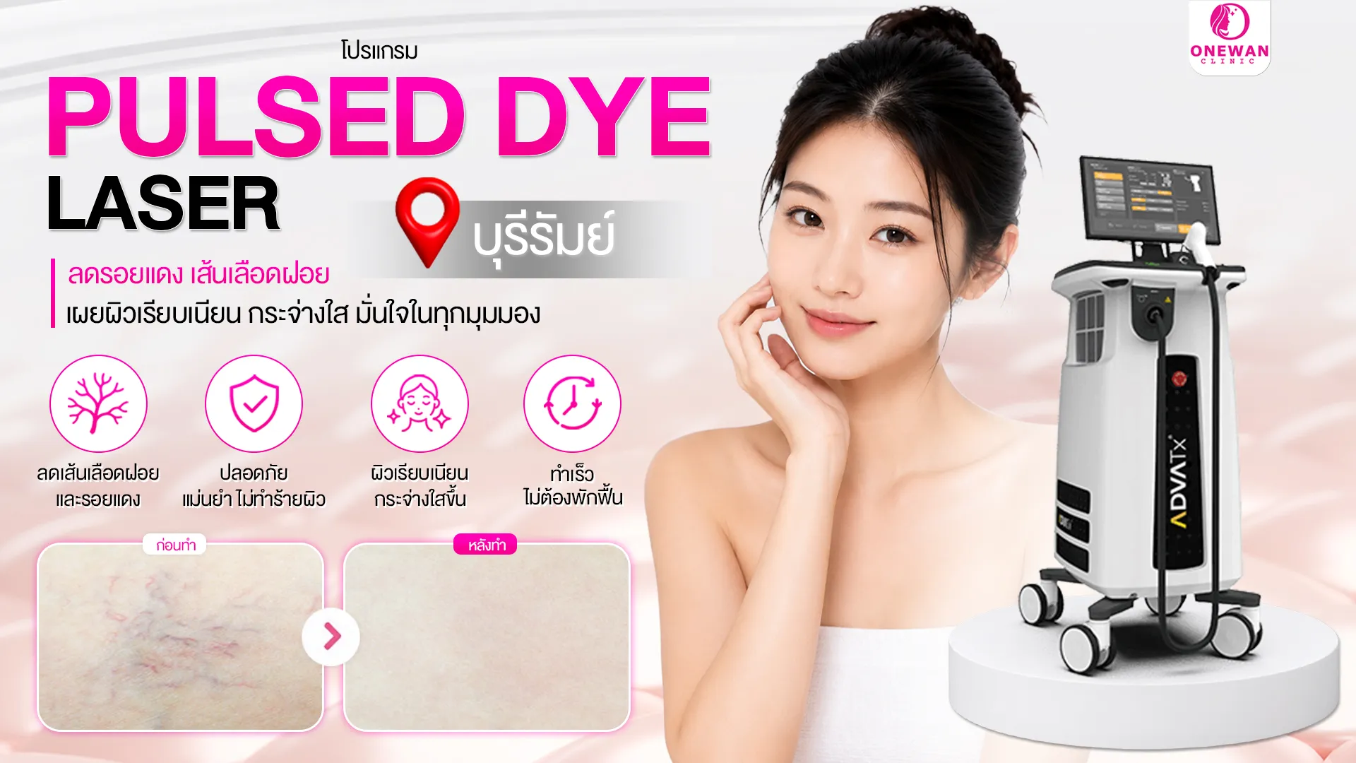 Pulse Dye Laser บุรีรัมย์