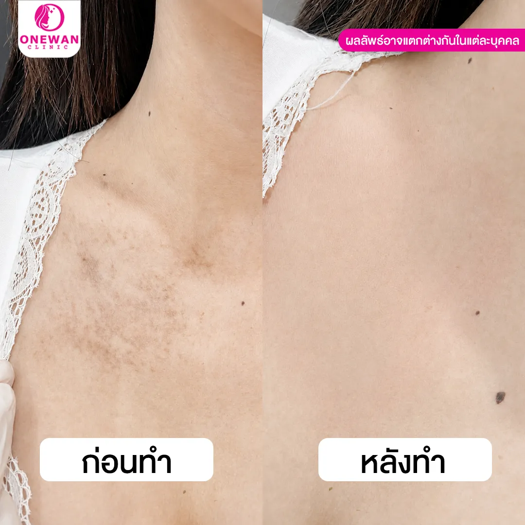 รีวิวเลเซอร์ปาน 1