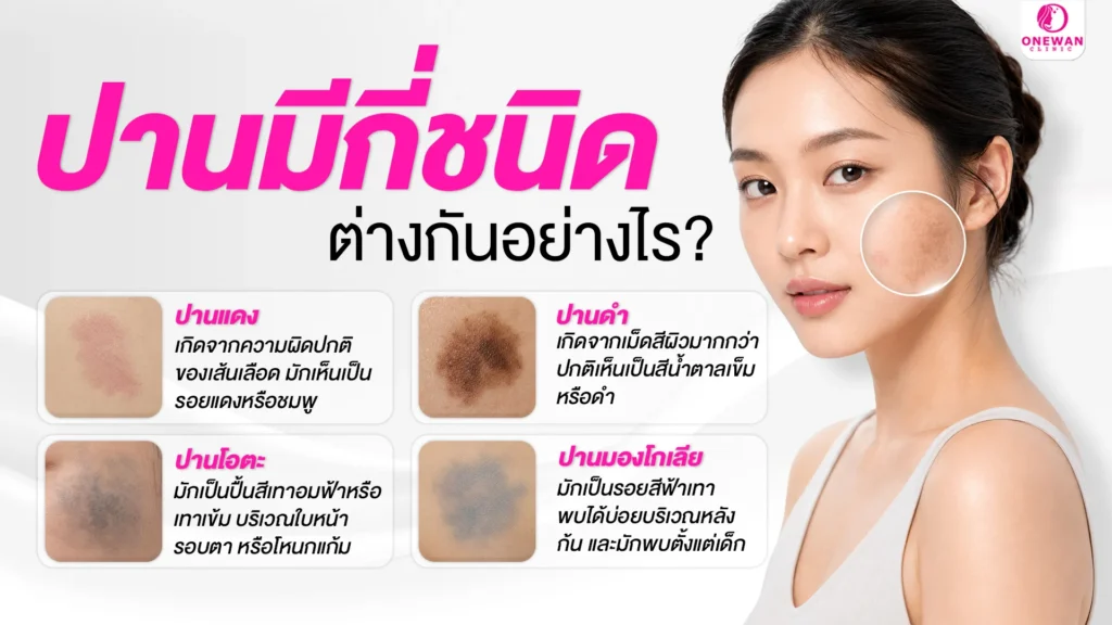 ปานมีกี่ชนิด ต่างกันอย่างไร