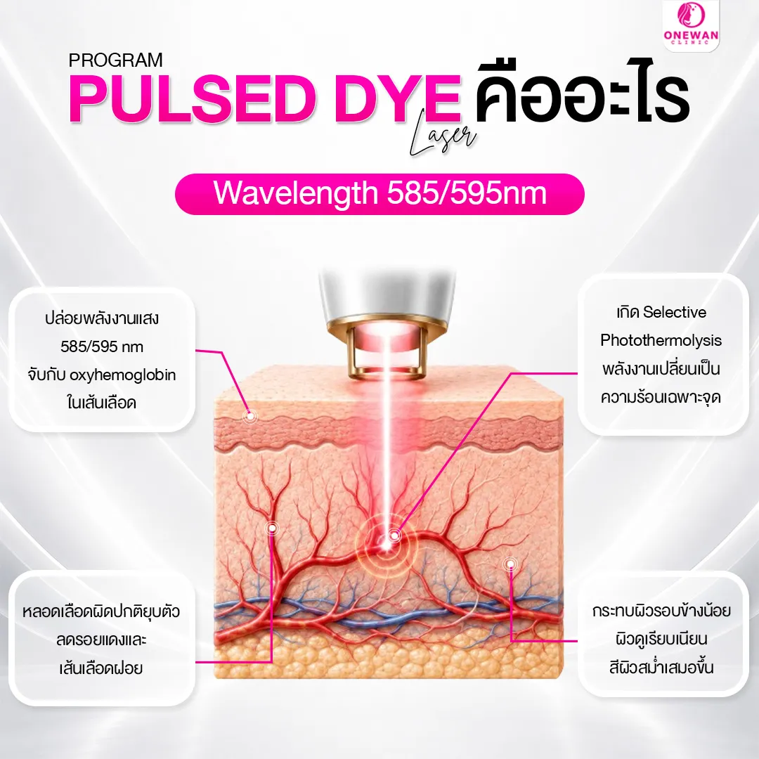 Pulse Dye Laser คืออะไร