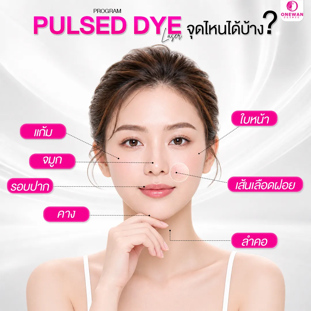 ทำ Pulse Dye Laser จุดไหนได้บ้าง