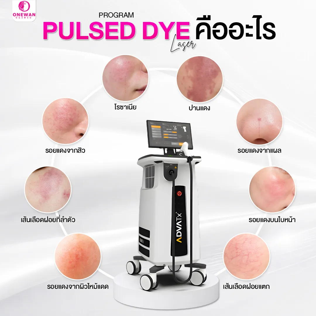 Pulse Dye Laser เหมาะกับใครบ้าง
