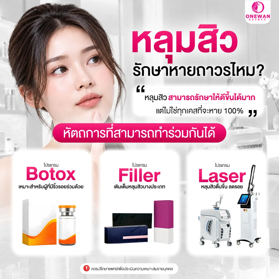 หลุมสิวรักษาหายถาวรไหม