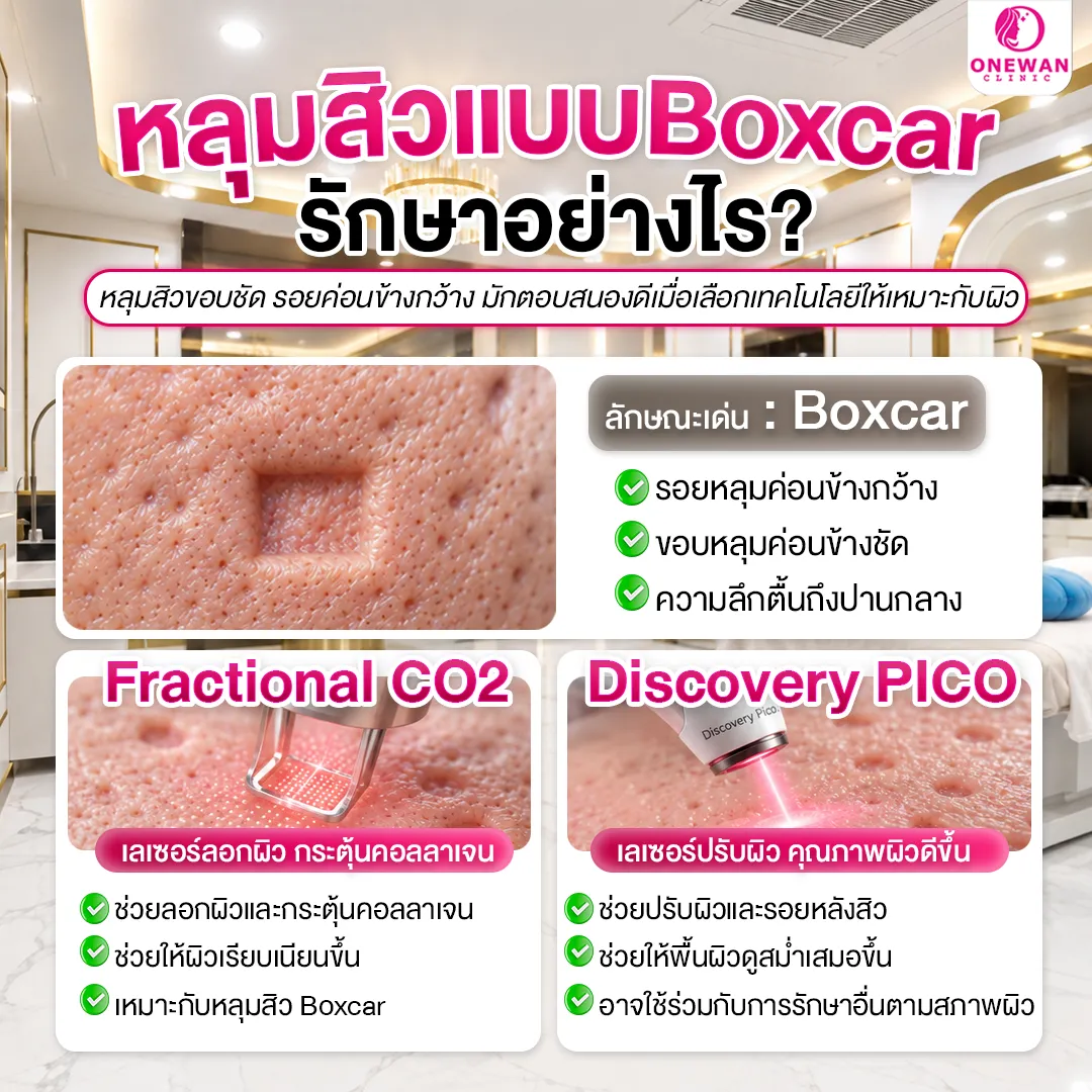หลุมสิวแบบ Boxcar รักษาอย่างไร
