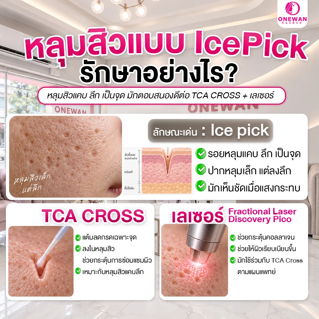 หลุมสิวแบบ Ice Pick รักษาอย่างไร