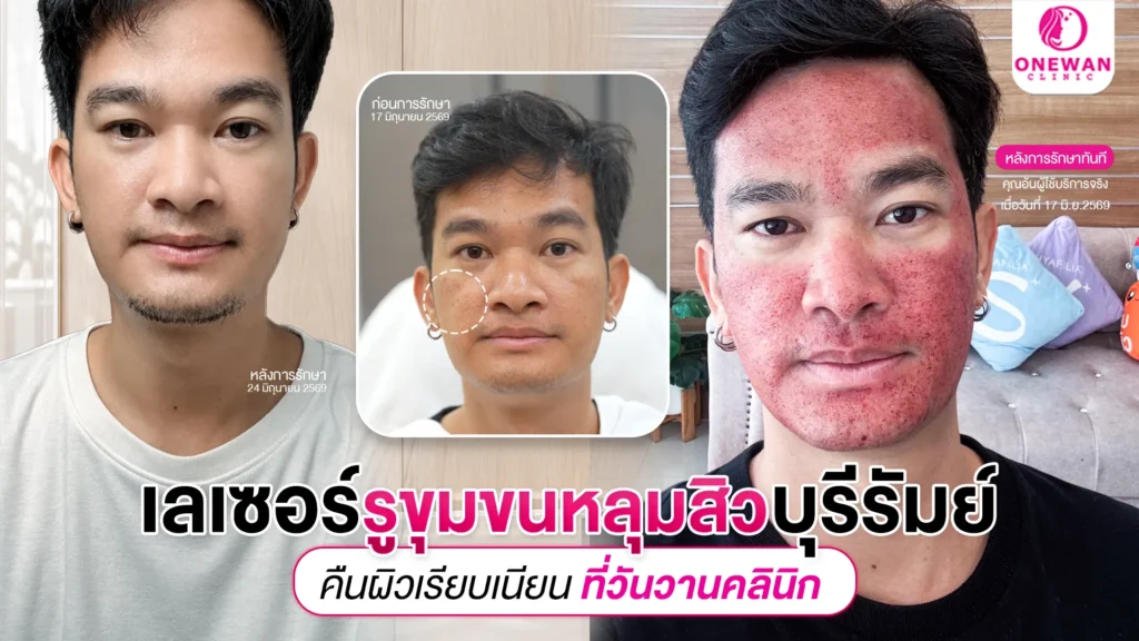 เลเซอร์ในช่องหลุมสิว บุรีรัมย์
