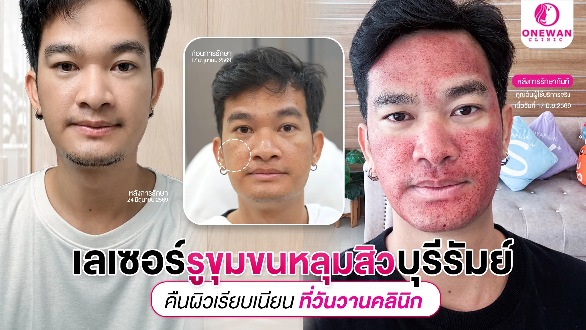 เลเซอร์ในช่องหลุมสิว บุรีรัมย์