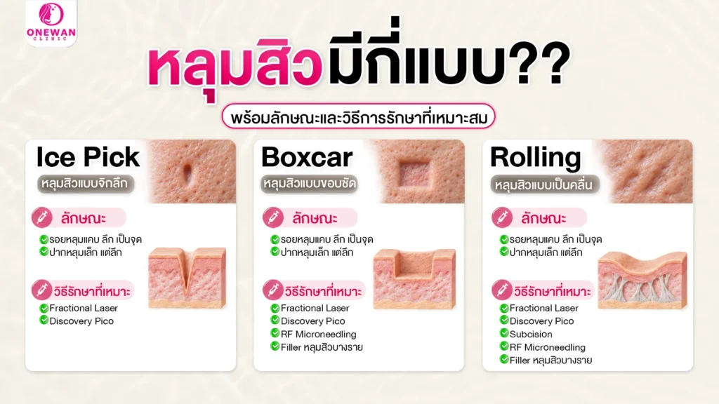 หลุมสิวมีกี่แบบ