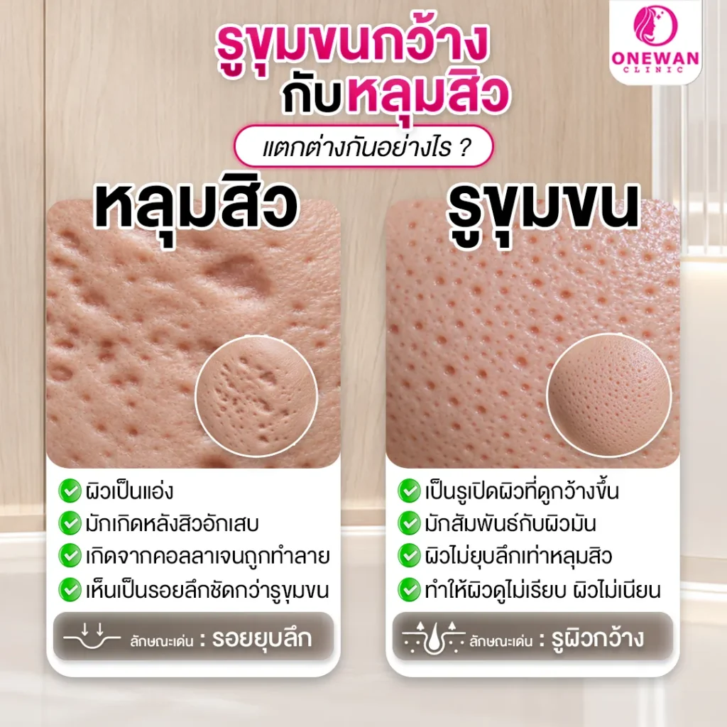 หลุมสิว รูขุมขนกว้าง ต่างกันอย่างไร