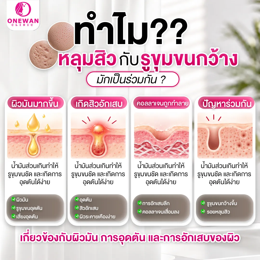 ทำไมหลุมสิวกับรูขุมขนกว้างมักเป็นร่วมกัน